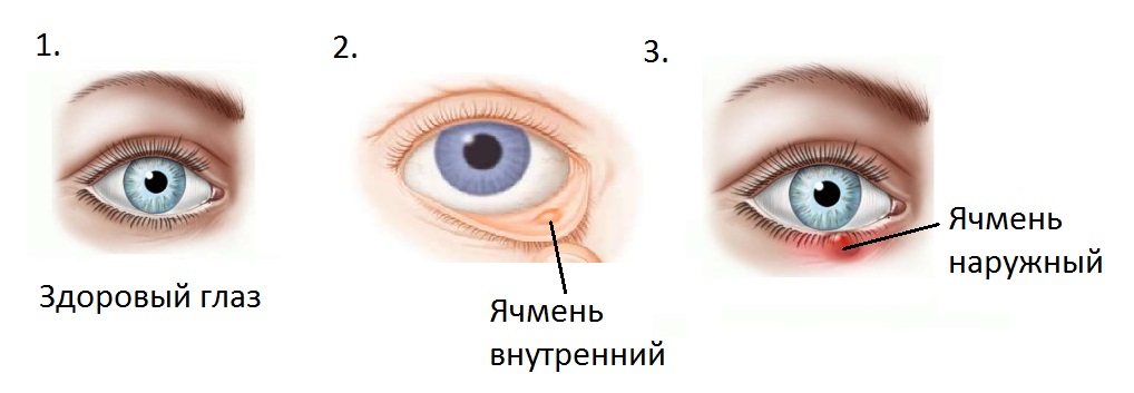 Признаки ячменя на глазу на начальной стадии. Несколько основных признаков появления ячменя на глазу