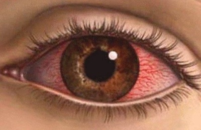 Термический ожог глаза первая помощь. Ожоги глаз. Ожог роговицы глаза, лечение. Капли - какие использовать