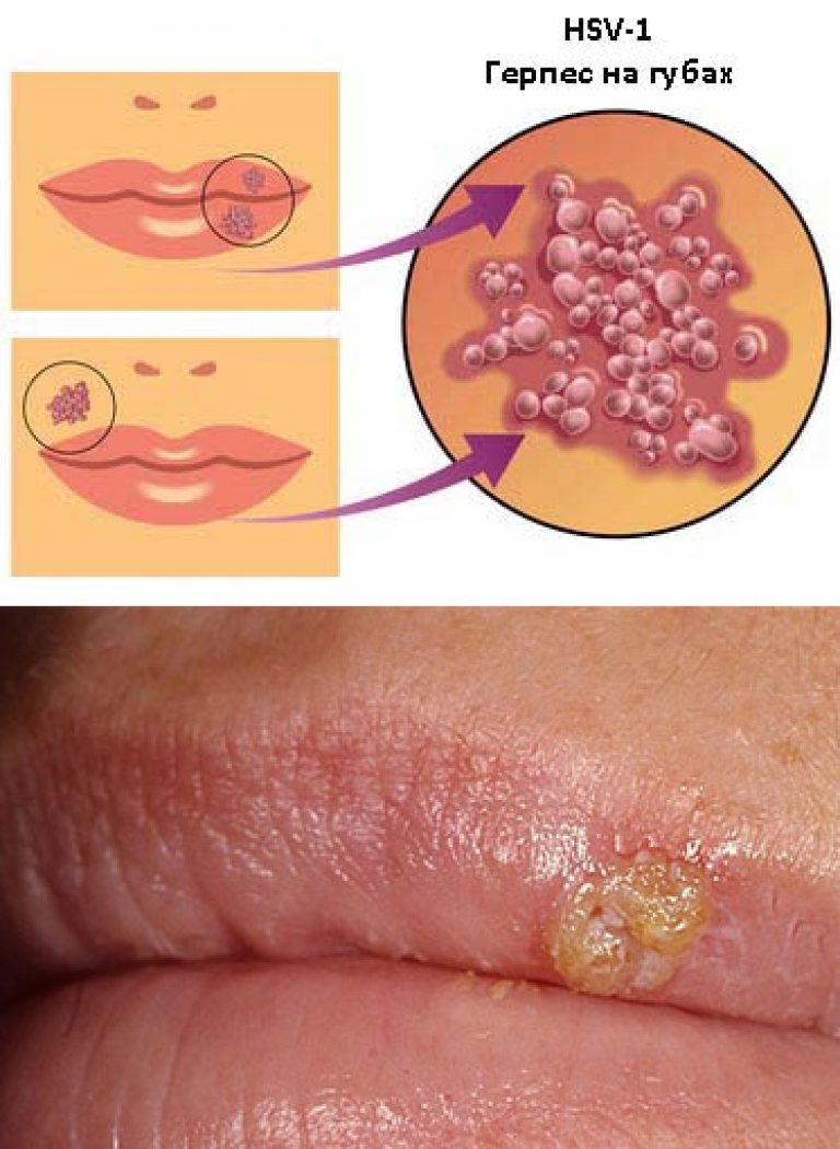 Dudaktaki Herpes: Nasıl bulaşır Dudaktaki herpes için bir çare. Herpes tehlikeli mi Dudaktaki Herpes: Nasıl bulaşır Dudaktaki herpes için bir çare. Herpes tehlikeli mi